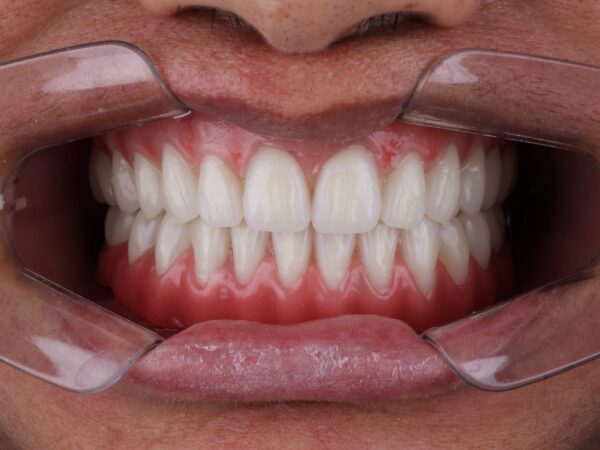 Prótese Kurlzer com Dente Premium